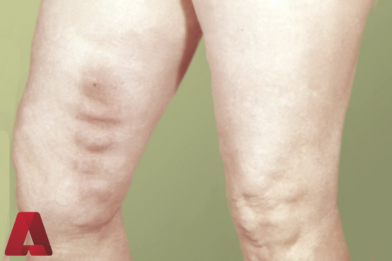 Qalxan varikotromboflebit